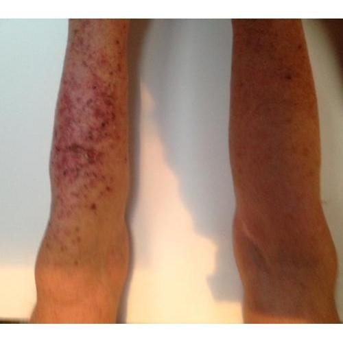 Chaga Mushroom Case Study. Learn how Chaga Mushroom was used as a treatment and reversal of Skin Cancer (Actinic Keratosis).-Annanda Chaga Reishi Turkey tail Mushrooms